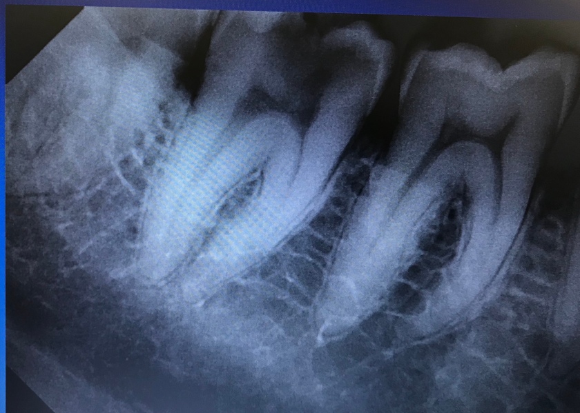 Bombed tooth